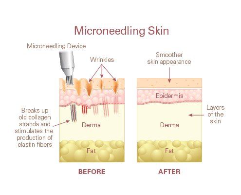 microneedling